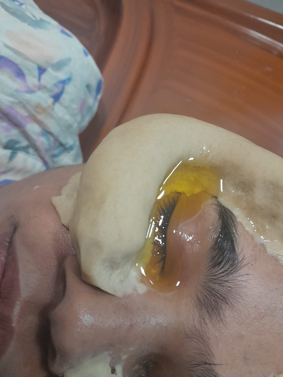Hair Loss, Leech Therapy and Weight Loss Treatments